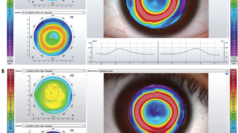 corneal topography showing ortho-K treatment zones