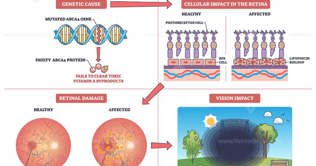 Visivra: Unraveling Stargardt Disease and the Promise of Gene Therapy for the Visual Cycle