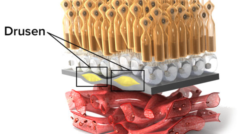 macula degeneration retina illustration