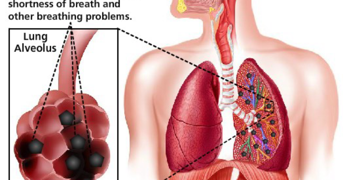 Pulmo Balance : Comment la pollution de l’air enflamme les alvéoles – Une analyse physiologique