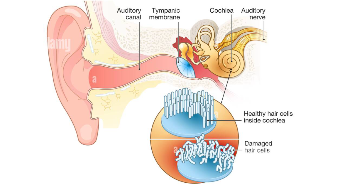 AquaPeace: How Dietary Salicylates and Glutamates Trigger Tinnitus Through Cochlear Excitotoxicity