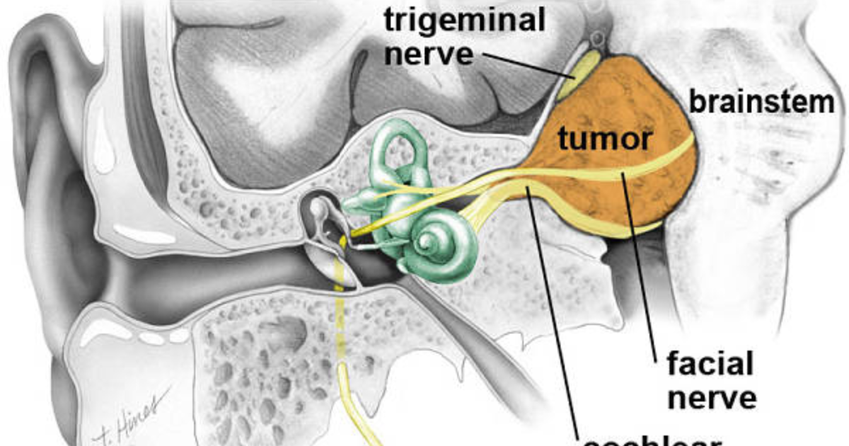 AquaPeace: Understanding the Trigeminal-Tinnitus Connection and How to Break the Cycle