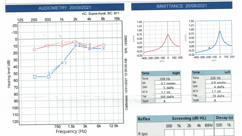 hearing test audiogram showing sudden hearing loss