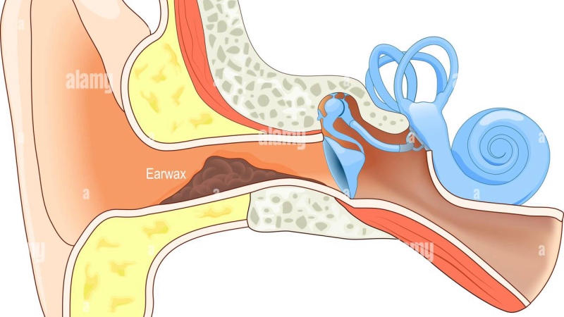 person with Meniere's vertigo holding ear