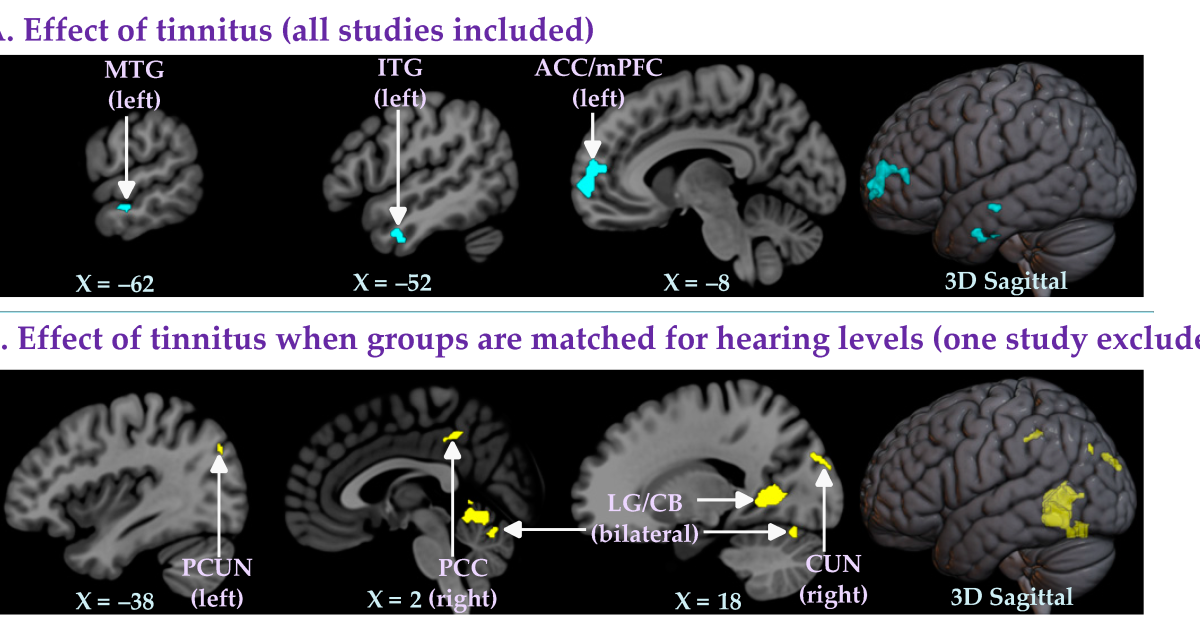 Neurocalm Pro: How Auditory Cortex Hyperactivity Creates Constant Tinnitus Ringing