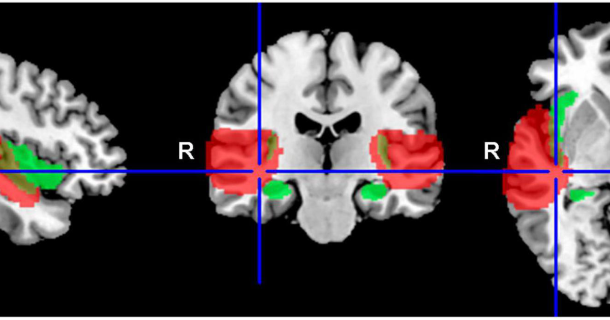Neurocalm Pro: New Brain Imaging Reveals How Tinnitus Sounds Are Generated