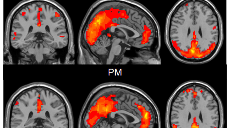 brain scan highlighting auditory cortex activity