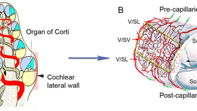 auditory cortex hyperactivity fMRI scan