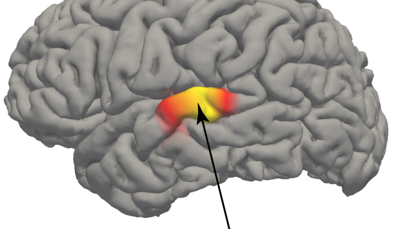 auditory cortex brain scan with hyperactivity highlighted