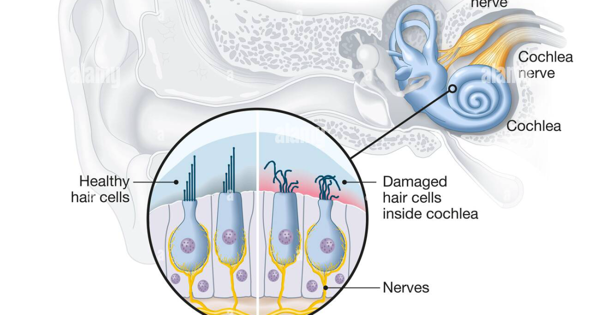 SonoVive: Oxidative Stress in the Inner Ear – A Biochemical Pathway to Tinnitus and Age-Related Hearing Loss