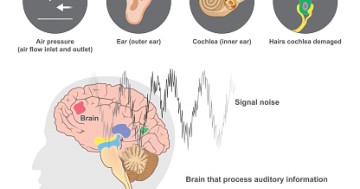 SonoVive: The Neuroscience of Phantom Ringing: How Auditory Cortex Hyperactivity Sustains Chronic Tinnitus