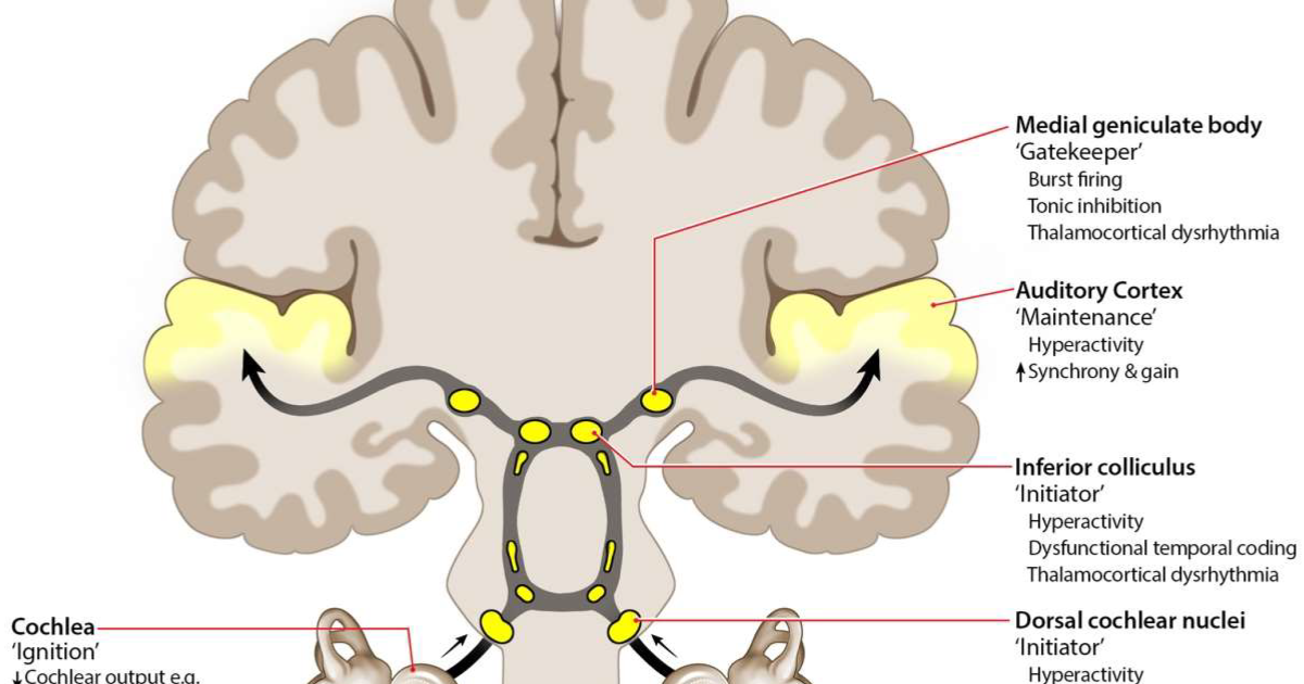 SonoVive: Tinnitus Retraining Therapy vs. Auditory Cortex Habituation – What the Latest Neuroscience Reveals