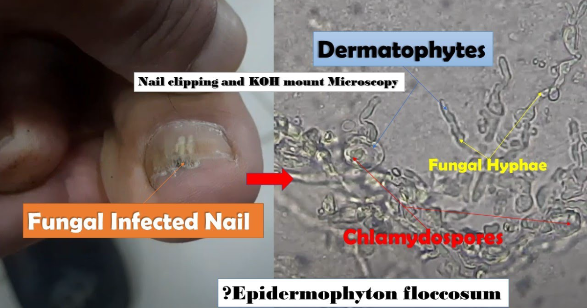 Terracalm: Clinical Report on the Physiological Mechanisms Behind Fungus Elixir and Its Efficacy for Nail Health