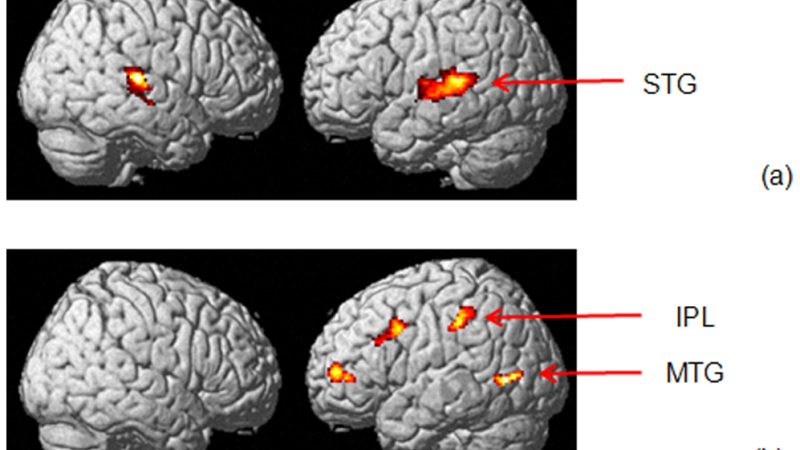 brain auditory cortex hyperactivity diagram