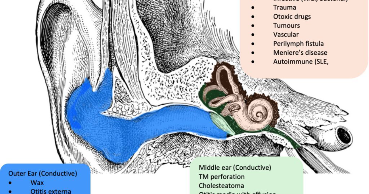 VidaCalm: Understanding Sudden Hearing Loss and the Ear Stroke Connection