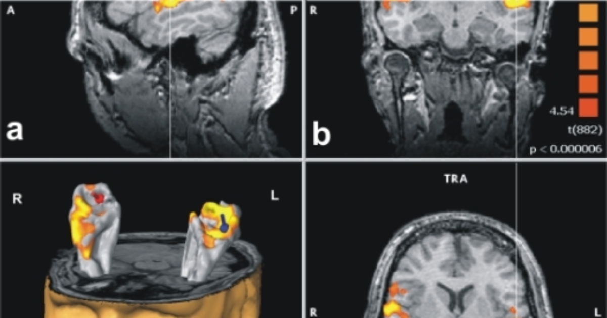 VidaCalm: Why Tinnitus Becomes Chronic – The Neuroscience of Maladaptive Plasticity