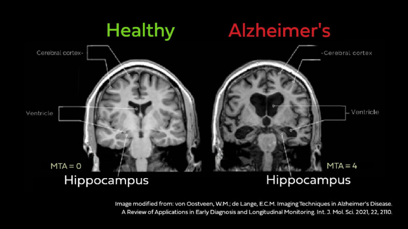 brain hippocampus neuron network