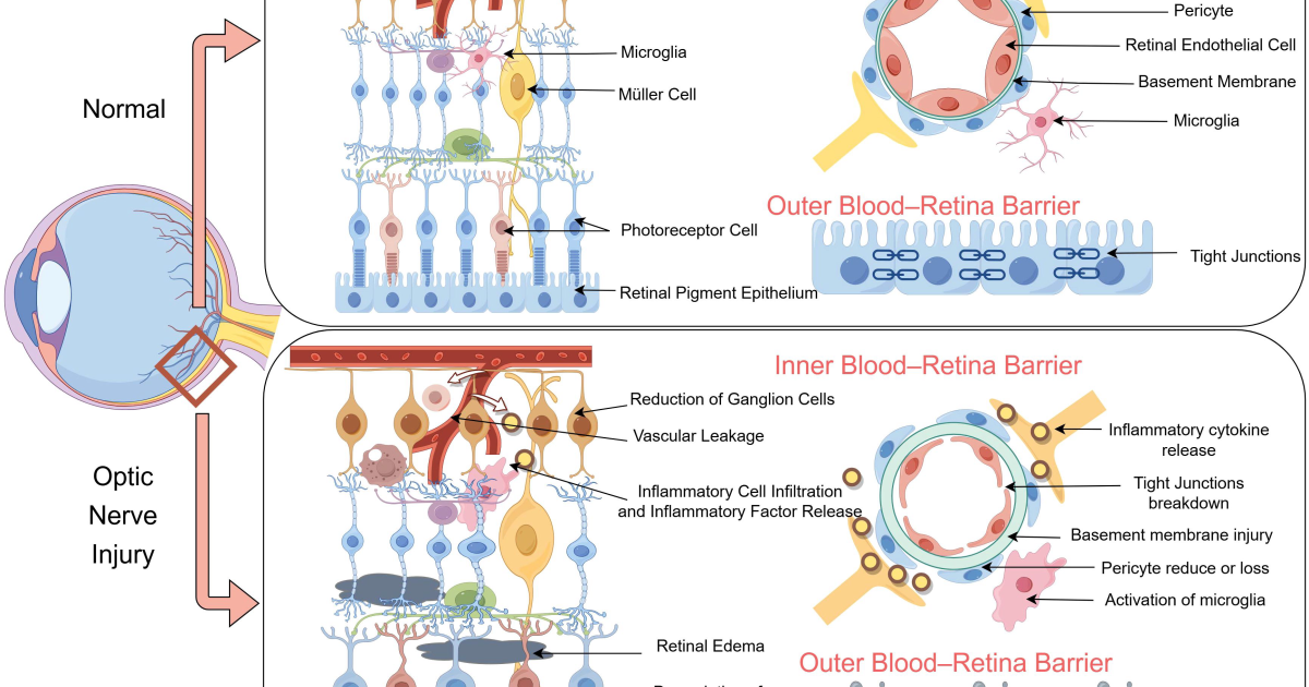 Visivra: La neuroinfiammazione nella neurite ottica e il potenziale di rimielinizzazione