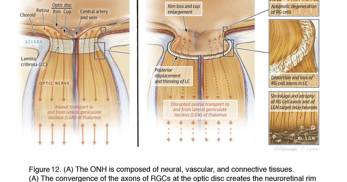 Visivra: Combattere la Morte delle Cellule Gangliari Retiniche nel Glaucoma con Strategie Neuroprotettive