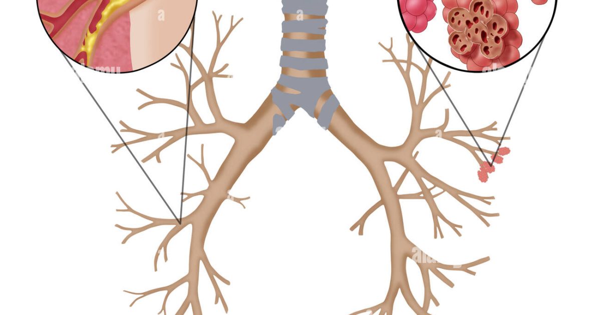Pulmo Balance: Il Beta-Glucano Riduce l'Infiammazione della BPCO – Nuove Evidenze Scientifiche