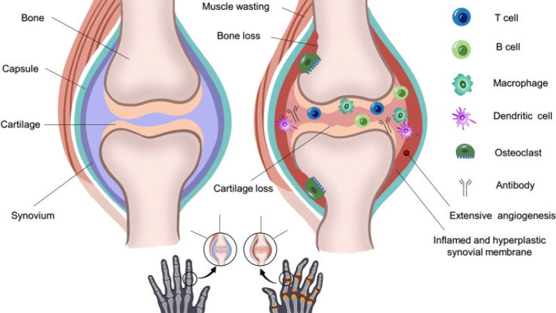microscopy image of healthy synovial fluid vs. osteoarthritic fluid