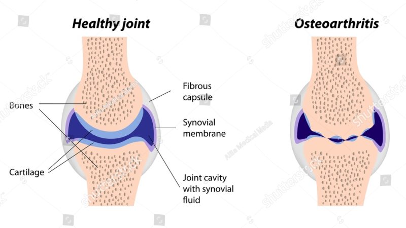 synovial fluid viscosity healthy vs osteoarthritis