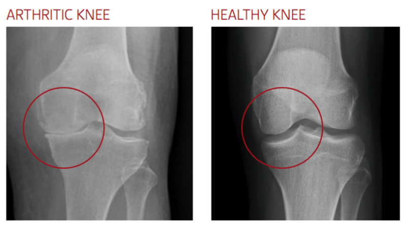 arthritic knee joint inflammation