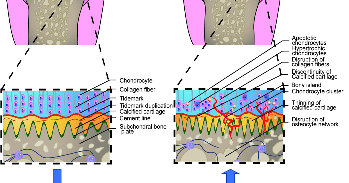 Arthro MD+: The Molecular Breakdown of Articular Cartilage and How to Protect It