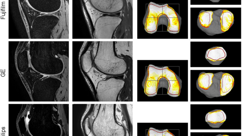 MRI scan showing cartilage thickness preservation in clinical trial
