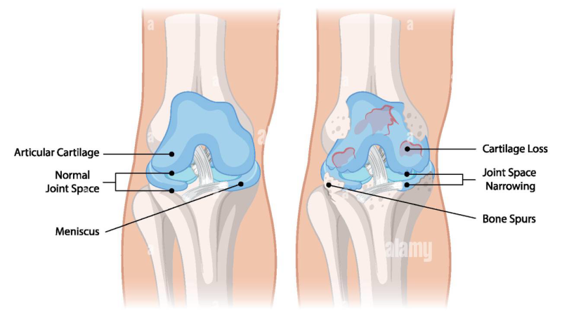 healthy and osteoarthritic joint comparison synovial fluid
