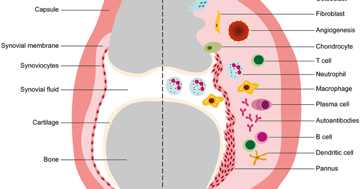 Arthryon: Blocking Inflammatory Cytokines – A New Frontier in Arthritis Relief Without Drugs