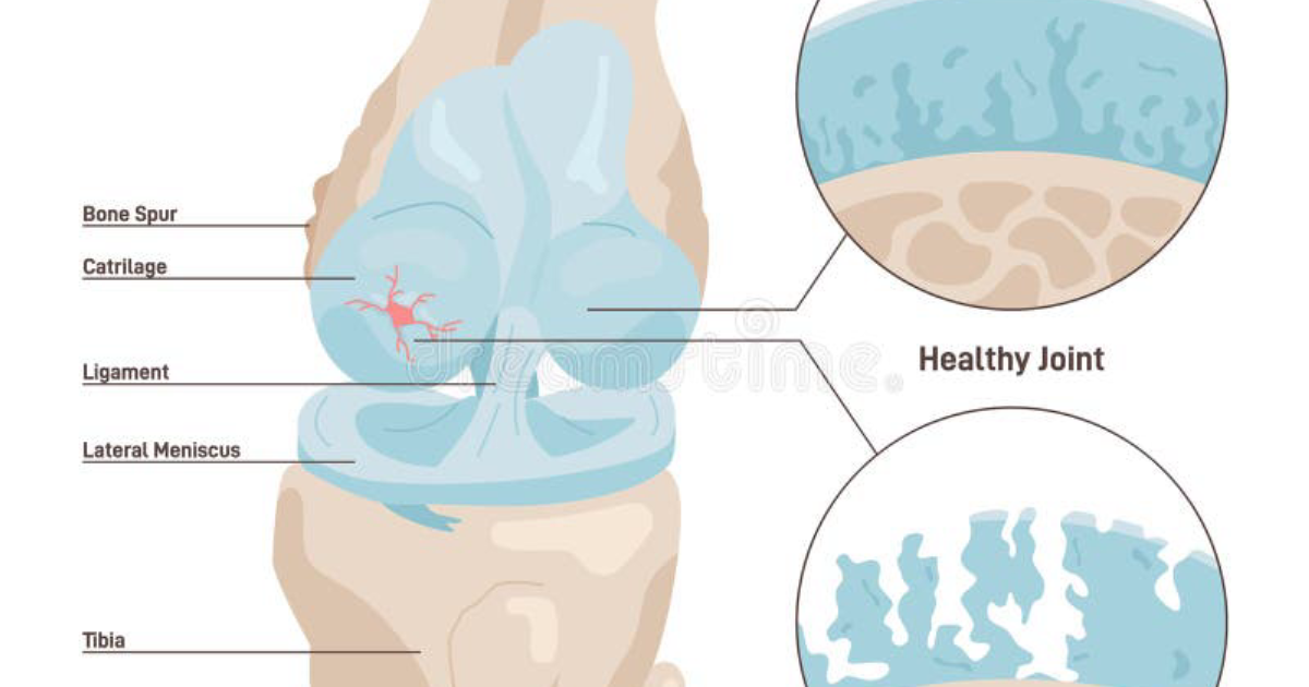 Arthryon: Breaking the Inflammatory Cycle That Erodes Your Cartilage