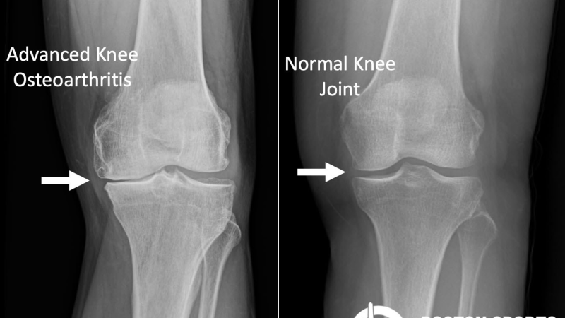 knee joint cross section showing synovial fluid and cartilage