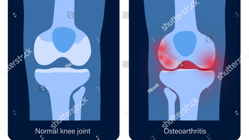 knee joint anatomy cartilage erosion illustration