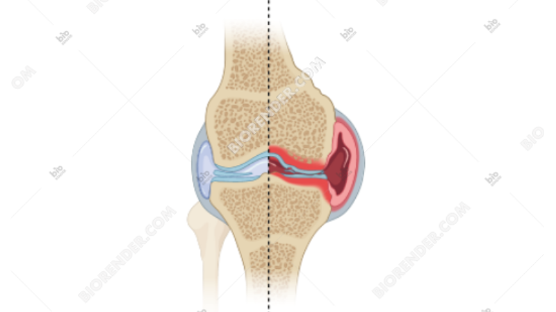 Microscopic view of healthy cartilage surface vs eroded cartilage