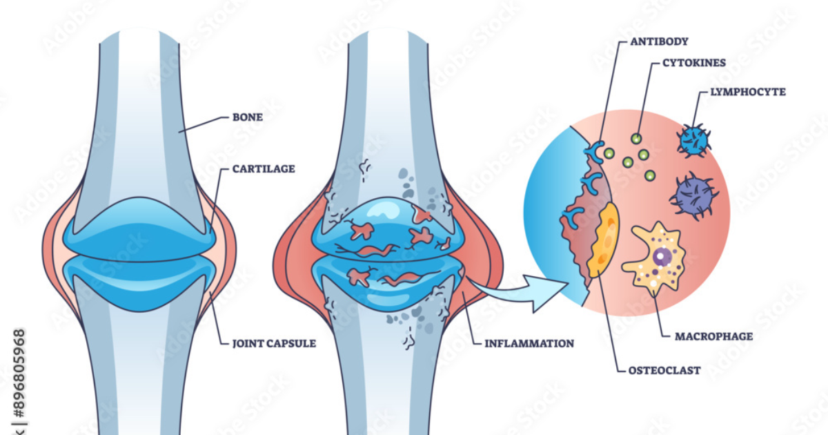 Arthryon: Suppressing Inflammatory Cytokines Naturally – A Scientific Approach to Joint Pain Relief