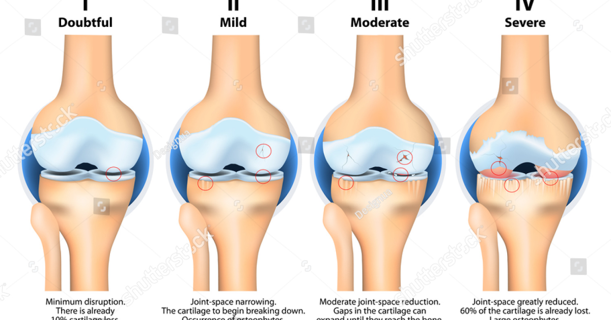 Arthryon: Targeting Inflammatory Pathways for Joint Pain Relief Without NSAIDs