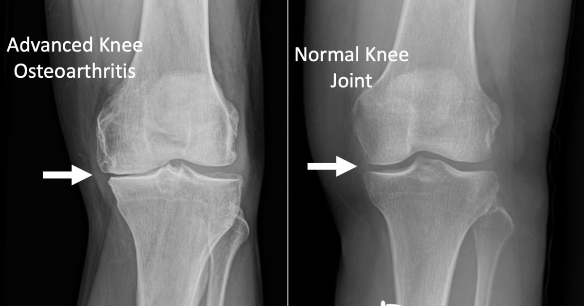 Artivorin: Restoring Joint Lubrication and Cartilage Integrity Through Targeted Nutritional Support