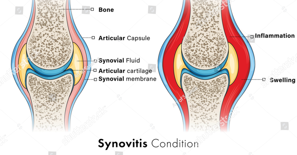 Nerve Calm: Breaking the Cytokine Storm in Your Joints