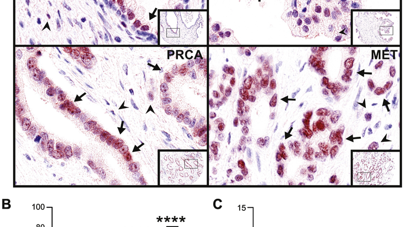 microscope slide showing prostate tissue stained for androgen receptors