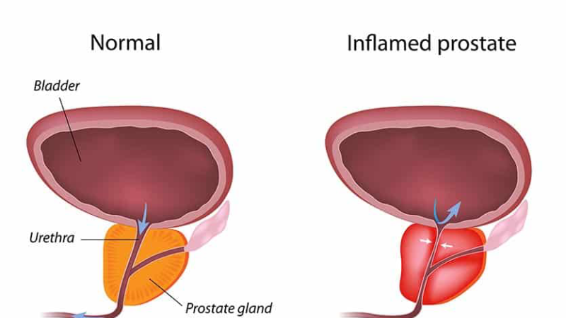 prostate anatomy illustration with inflamed tissue