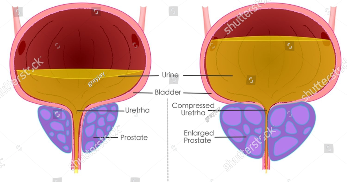PotentStream: The Cellular Mechanisms of Urinary Retention — How Prostatic Smooth Muscle Tone and Rho Kinase Affect Your Flow