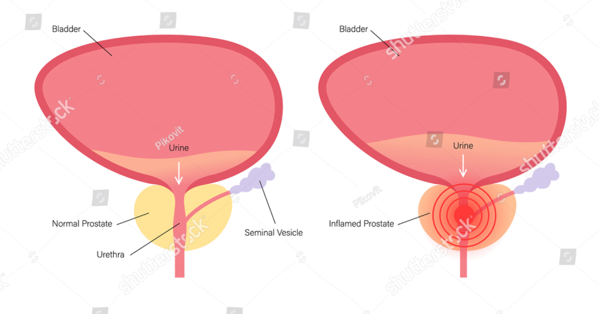 Primal Grow Pro: Beyond Saw Palmetto – The Science of Reducing Prostate Cellular Inflammation Naturally