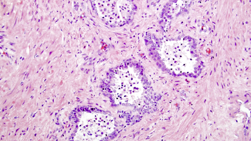 microscopic prostate tissue showing inflammation