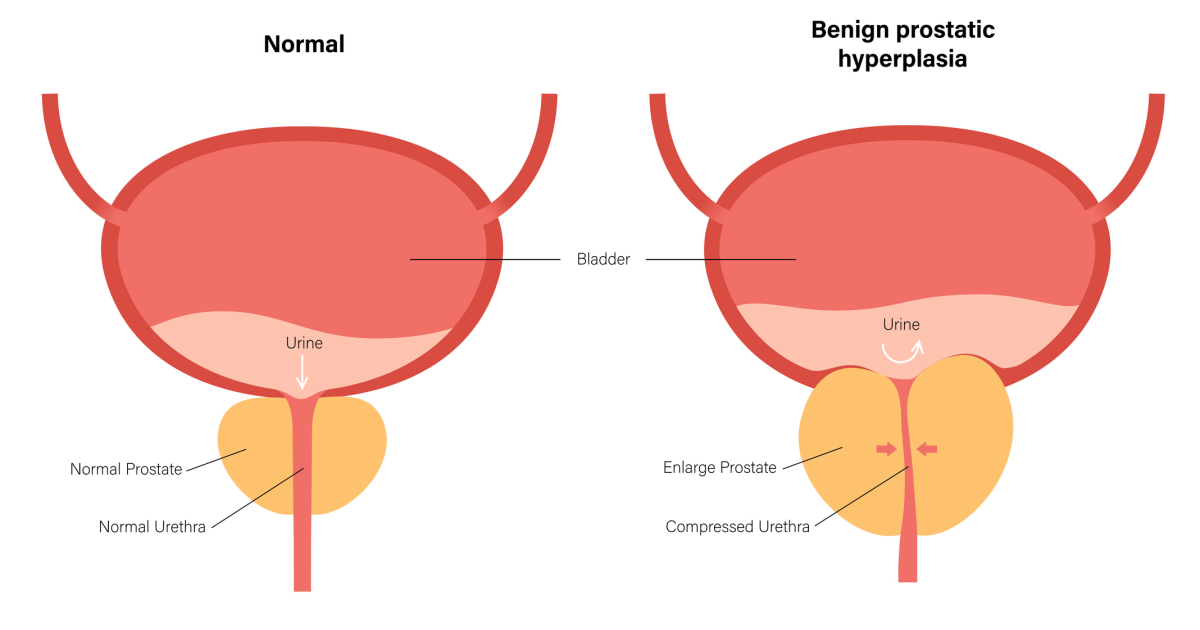 Primal Grow Pro: How Chronic Prostatic Inflammation Disrupts Urinary Health and What Science Has Discovered