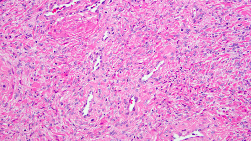 prostate tissue cross section inflammation cytokines