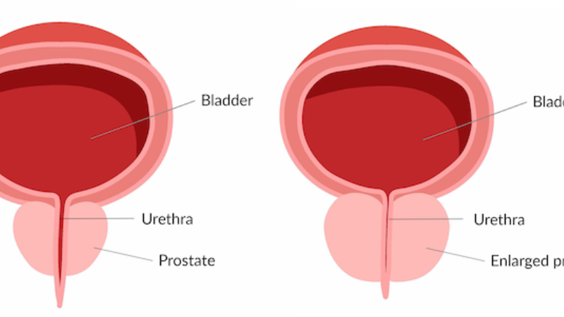 cross-section of enlarged prostate pressing on urethra