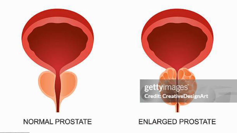 prostate urethra cross section showing enlargement