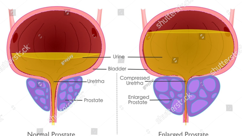 healthy prostate vs inflamed prostate illustration