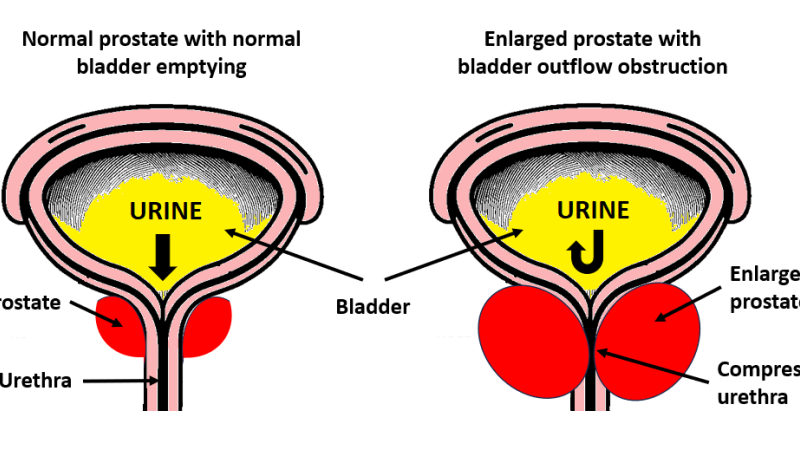 prostate anatomy showing transition zone and urethra compression